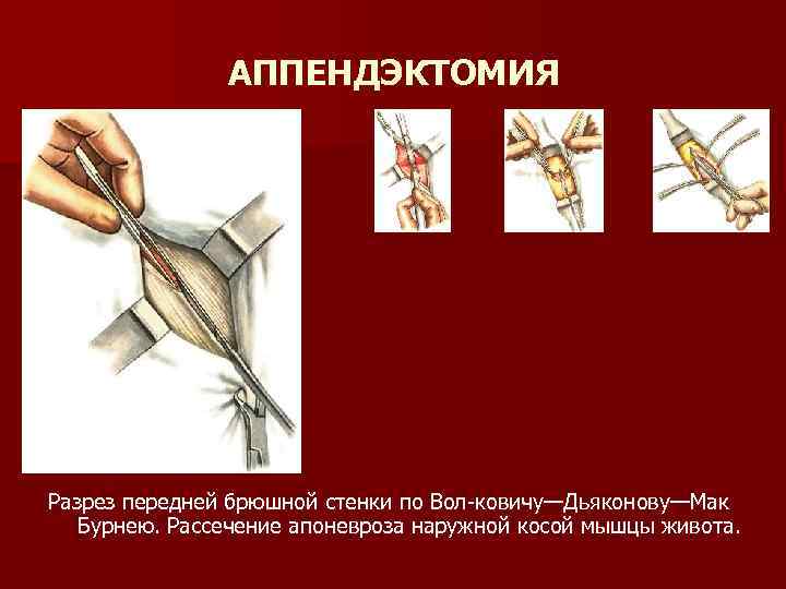 АППЕНДЭКТОМИЯ Разрез передней брюшной стенки по Вол-ковичу—Дьяконову—Мак Бурнею. Рассечение апоневроза наружной косой мышцы живота.