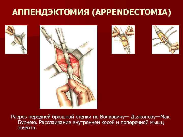 АППЕНДЭКТОМИЯ (APPENDECTOMIA) Разрез передней брюшной стенки по Волковичу— Дьяконову—Мак Бурнею. Расслаивание внутренней косой и