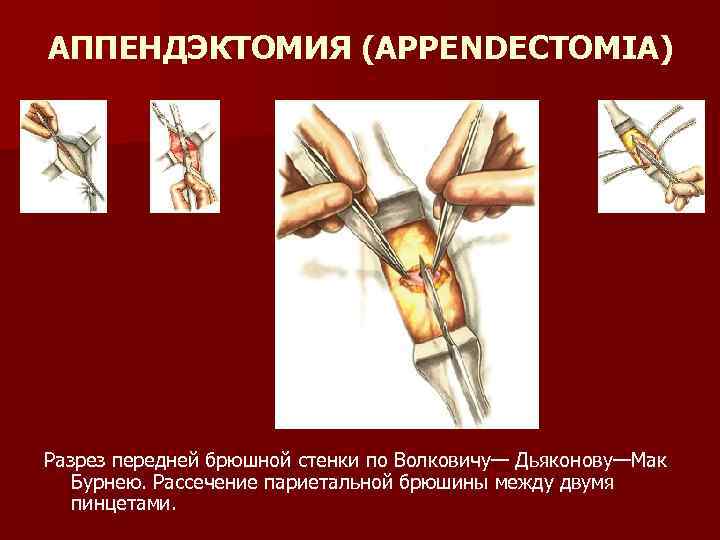 АППЕНДЭКТОМИЯ (APPENDECTOMIA) Разрез передней брюшной стенки по Волковичу— Дьяконову—Мак Бурнею. Рассечение париетальной брюшины между