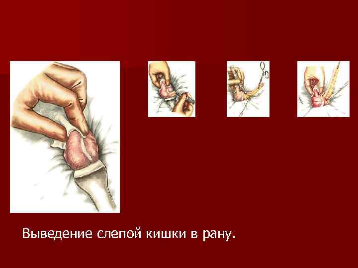 Выведение слепой кишки в рану. 