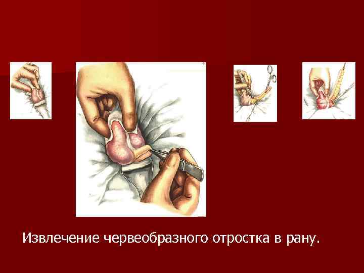 Извлечение червеобразного отростка в рану. 