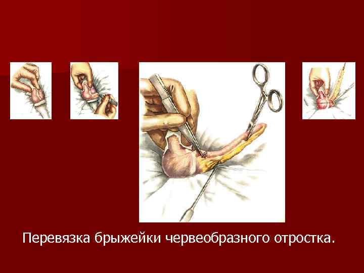 Перевязка брыжейки червеобразного отростка. 