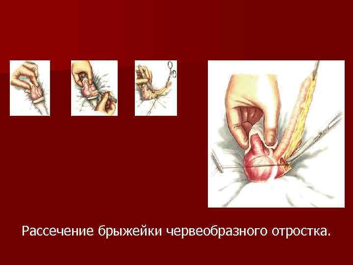 Рассечение брыжейки червеобразного отростка. 