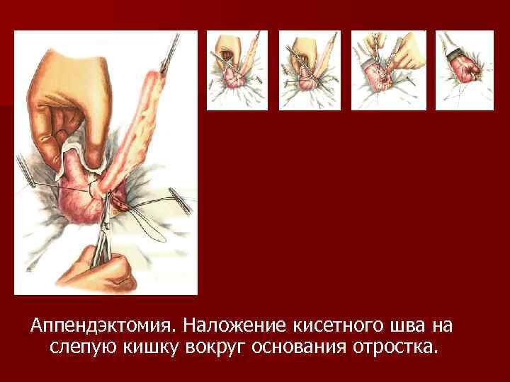 Аппендэктомия. Наложение кисетного шва на слепую кишку вокруг основания отростка. 