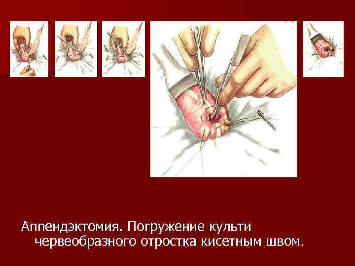 Аппендэктомия. Погружение культи червеобразного отростка кисетным швом. 