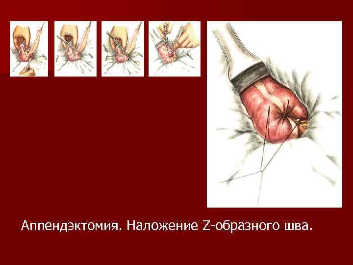 Аппендэктомия. Наложение Z-образного шва. 