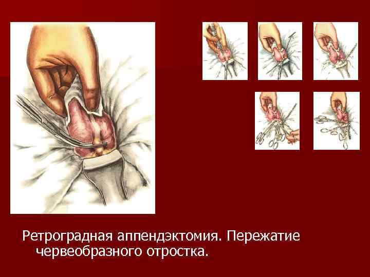 Ретроградная аппендэктомия. Пережатие червеобразного отростка. 