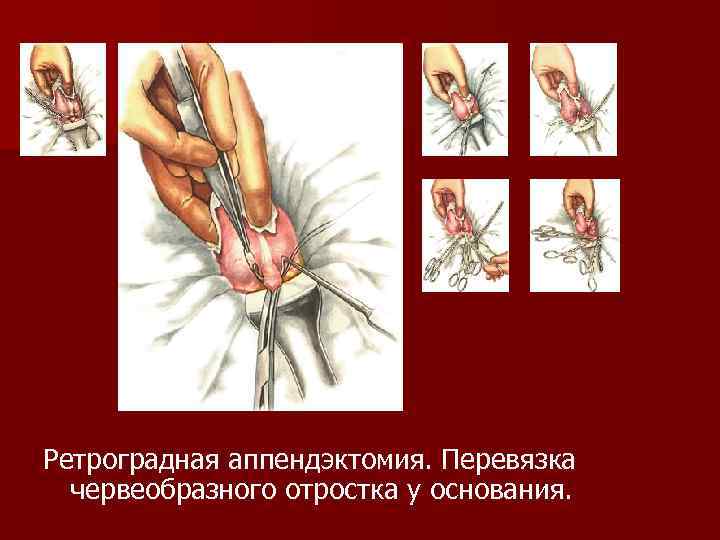 Ретроградная аппендэктомия. Перевязка червеобразного отростка у основания. 