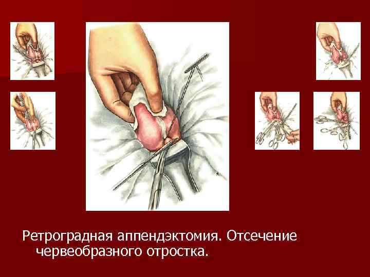 Ретроградная аппендэктомия. Отсечение червеобразного отростка. 