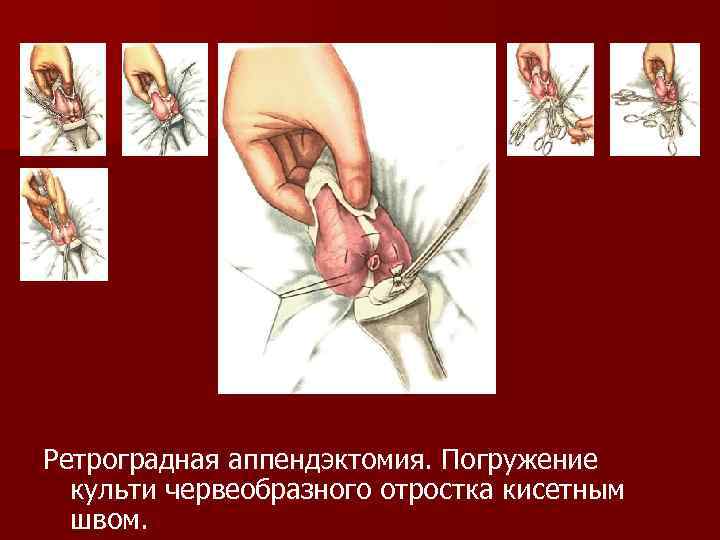 Ретроградная аппендэктомия. Погружение культи червеобразного отростка кисетным швом. 