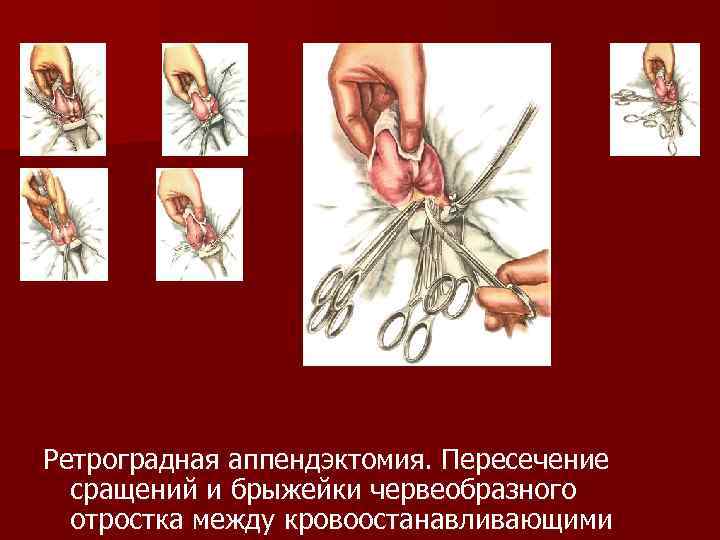 Ретроградная аппендэктомия. Пересечение сращений и брыжейки червеобразного отростка между кровоостанавливающими 