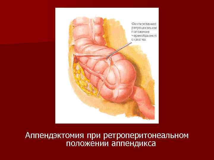 Аппендэктомия при ретроперитонеальном положении аппендикса 