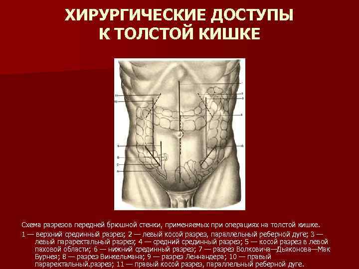 ХИРУРГИЧЕСКИЕ ДОСТУПЫ К ТОЛСТОЙ КИШКЕ Схема разрезов передней брюшной стенки, применяемых при операциях на
