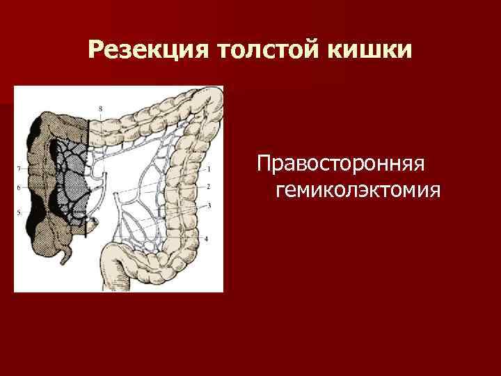 Резекция толстой кишки Правосторонняя гемиколэктомия 
