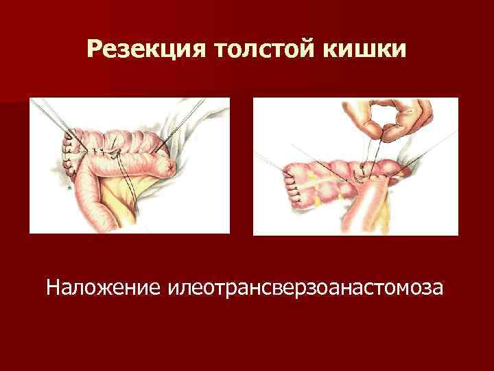 Резекция толстой кишки Наложение илеотрансверзоанастомоза 