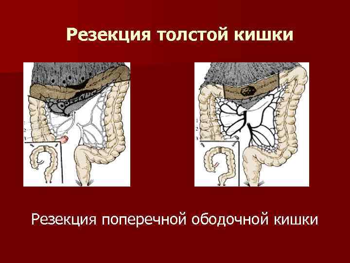 Резекция толстой кишки Резекция поперечной ободочной кишки 