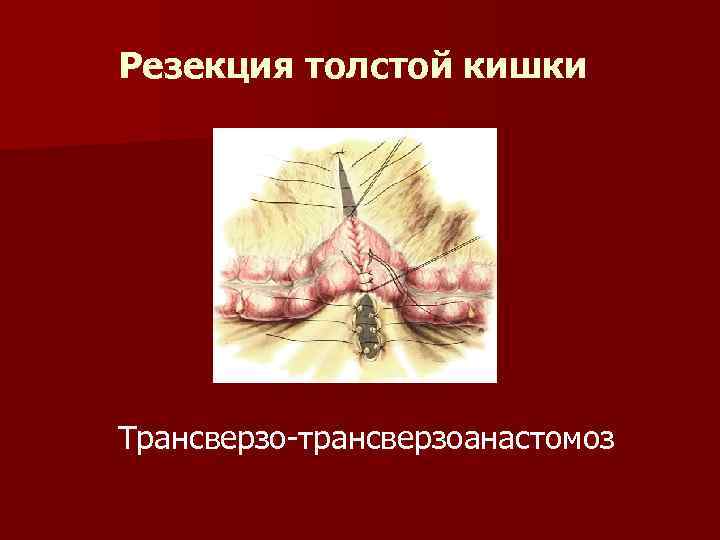 Резекция толстой кишки Трансверзо-трансверзоанастомоз 