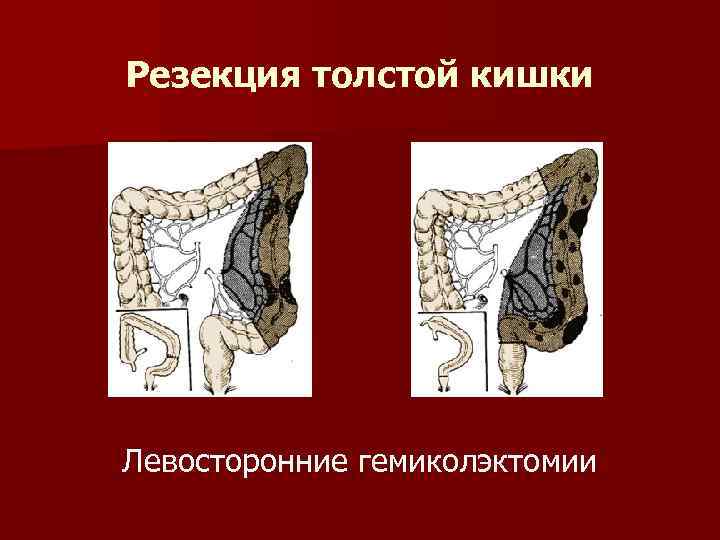 Резекция толстой кишки Левосторонние гемиколэктомии 