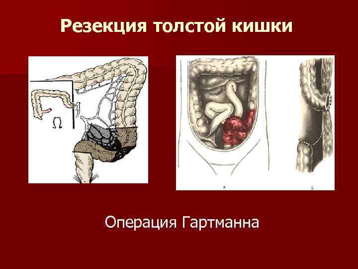 Резекция толстой кишки Операция Гартманна 