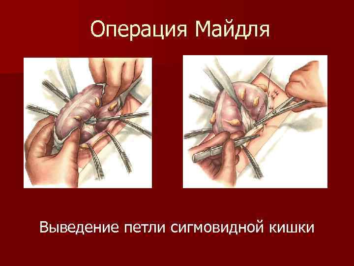 Операция Майдля Выведение петли сигмовидной кишки 