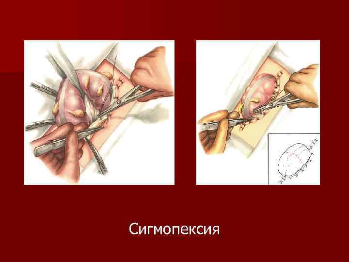 Сигмопексия 