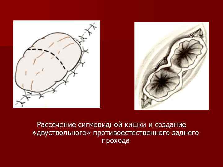 Рассечение сигмовидной кишки и создание «двуствольного» противоестественного заднего прохода 