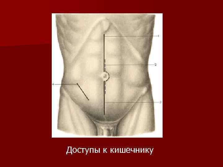 Доступы к кишечнику 