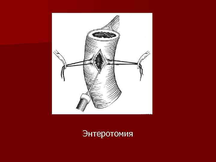 Энтеротомия 