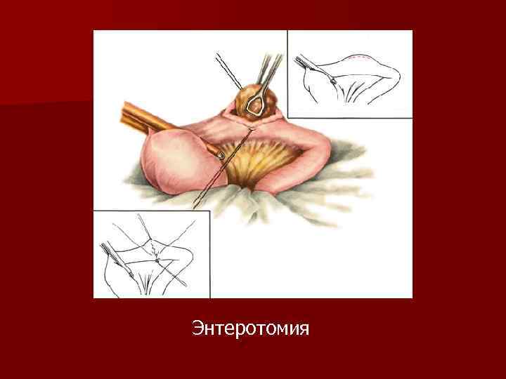 Энтеротомия 