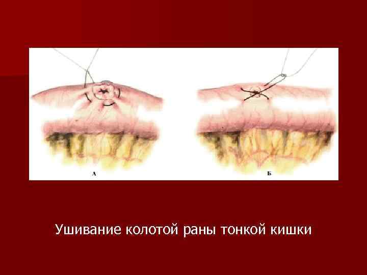 Ушивание колотой раны тонкой кишки 