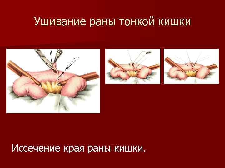Ушивание раны тонкой кишки Иссечение края раны кишки. 