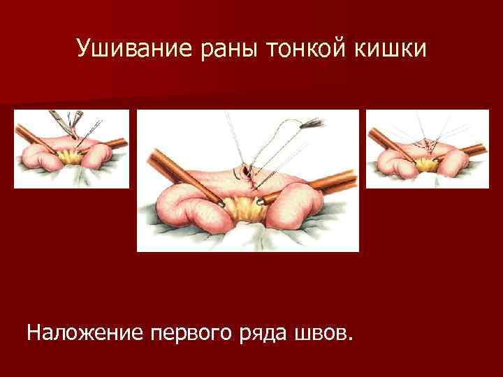 Ушивание раны тонкой кишки Наложение первого ряда швов. 