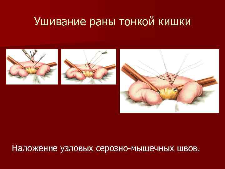 Ушивание раны тонкой кишки Наложение узловых серозно-мышечных швов. 