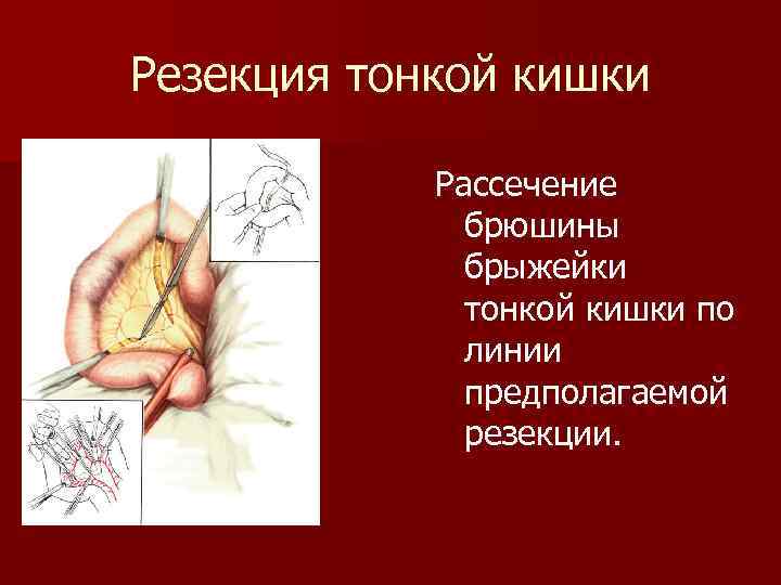 Резекция тонкой кишки Рассечение брюшины брыжейки тонкой кишки по линии предполагаемой резекции. 