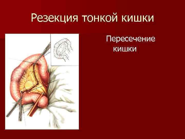 Резекция тонкой кишки Пересечение кишки 