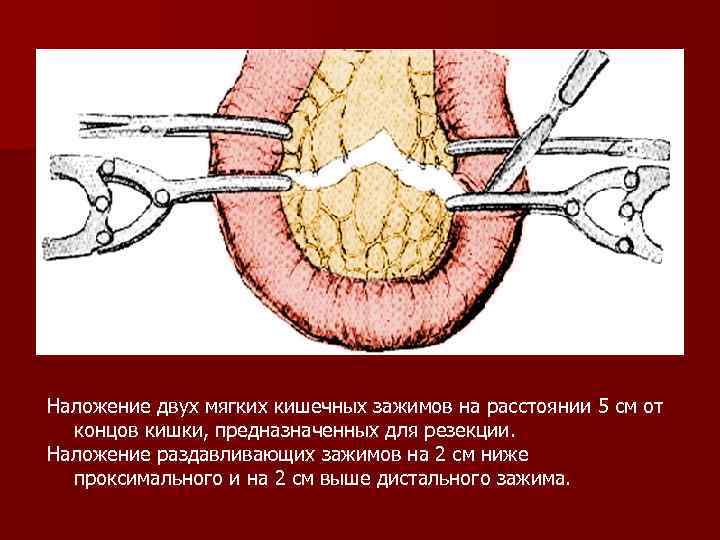 Наложение двух мягких кишечных зажимов на расстоянии 5 см от концов кишки, предназначенных для