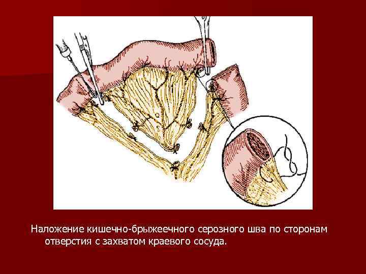 Наложение кишечно-брыжеечного серозного шва по сторонам отверстия с захватом краевого сосуда. 