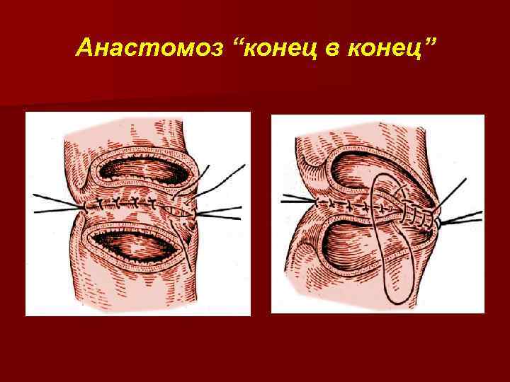 Анастомоз “конец в конец” 
