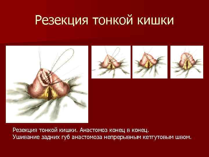 Резекция тонкой кишки. Анастомоз конец в конец. Ушивание задних губ анастомоза непрерывным кетгутовым швом.