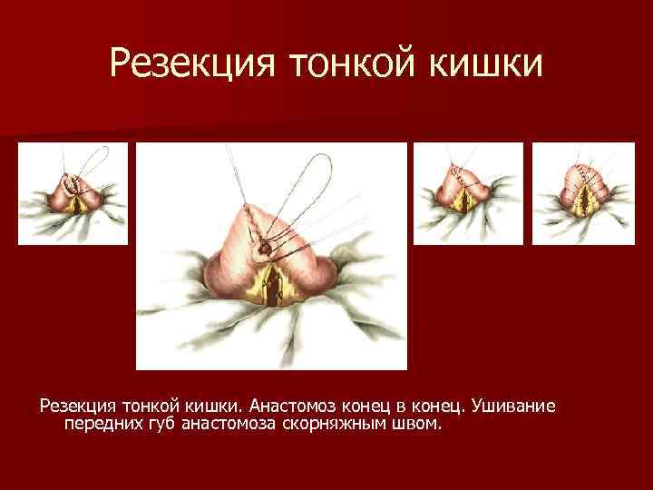 Резекция тонкой кишки. Анастомоз конец в конец. Ушивание передних губ анастомоза скорняжным швом. 