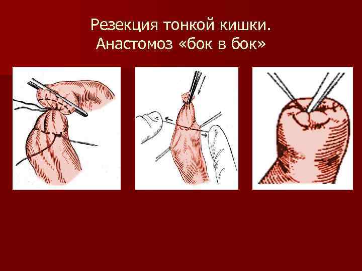 Резекция тонкой кишки. Анастомоз «бок в бок» 