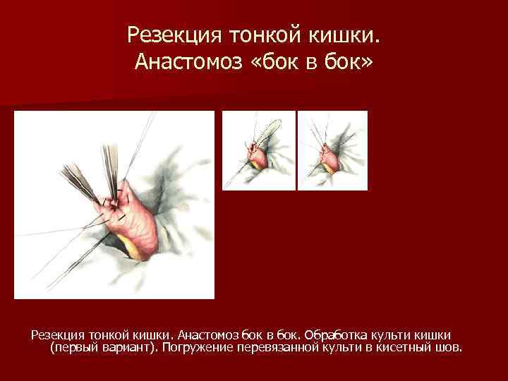 Резекция тонкой кишки. Анастомоз «бок в бок» Резекция тонкой кишки. Анастомоз бок в бок.
