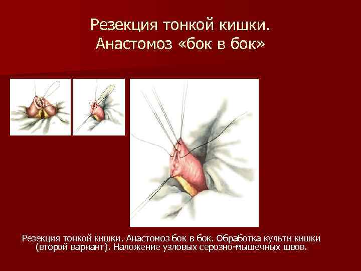 Резекция тонкой кишки. Анастомоз «бок в бок» Резекция тонкой кишки. Анастомоз бок в бок.