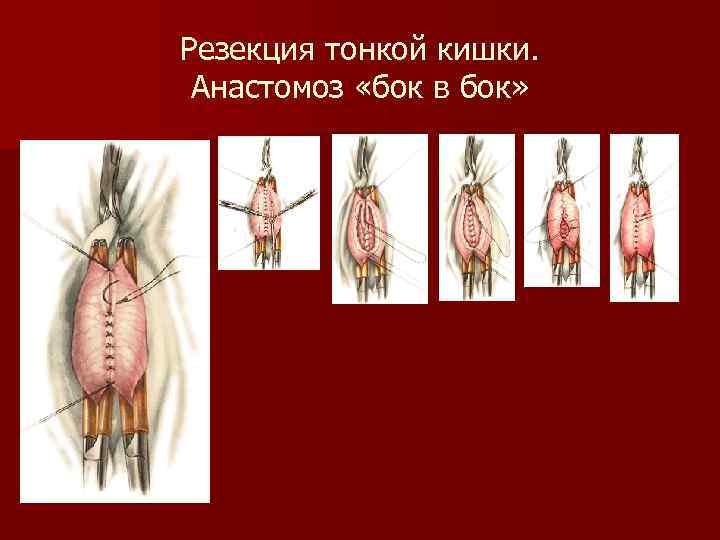 Резекция тонкой кишки. Анастомоз «бок в бок» 