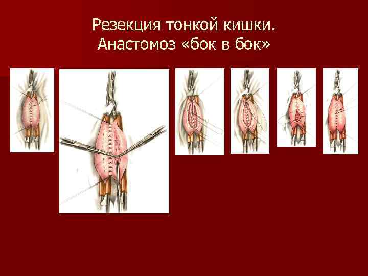 Резекция тонкой кишки. Анастомоз «бок в бок» 