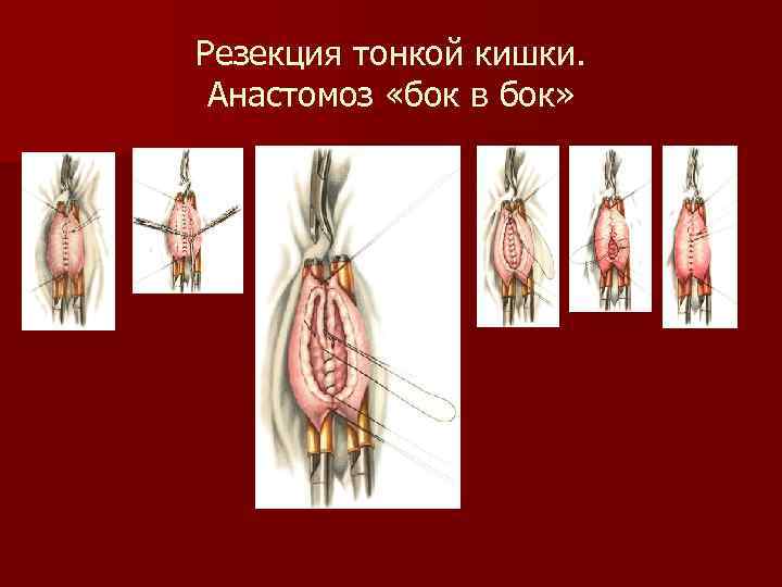 Резекция тонкой кишки. Анастомоз «бок в бок» 