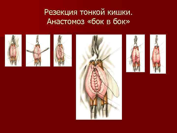 Резекция тонкой кишки. Анастомоз «бок в бок» 