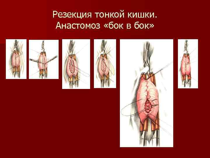 Резекция тонкой кишки. Анастомоз «бок в бок» 