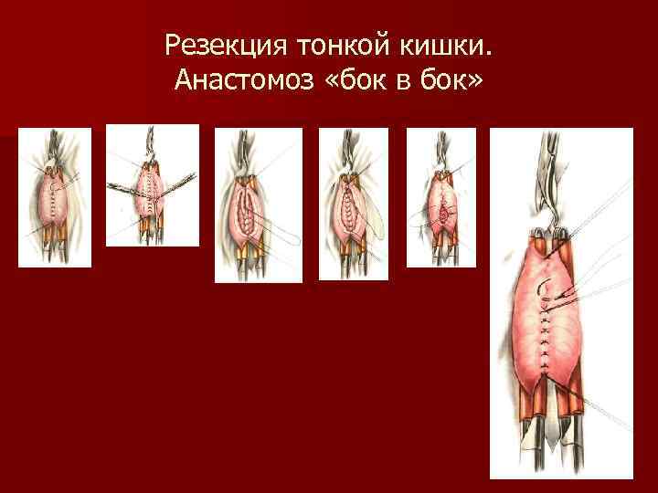 Резекция тонкой кишки. Анастомоз «бок в бок» 