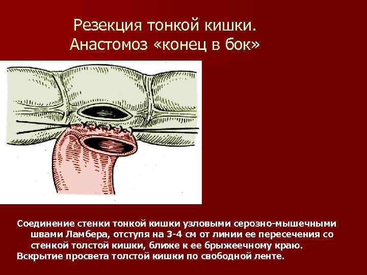 Резекция тонкой кишки. Анастомоз «конец в бок» Соединение стенки тонкой кишки узловыми серозно-мышечными швами